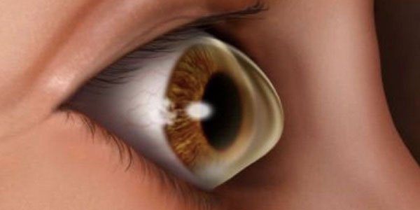 Cornea Services