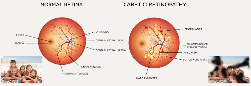 Diabetic Retinopathy