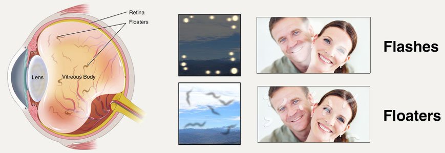 Flashes and Floaters