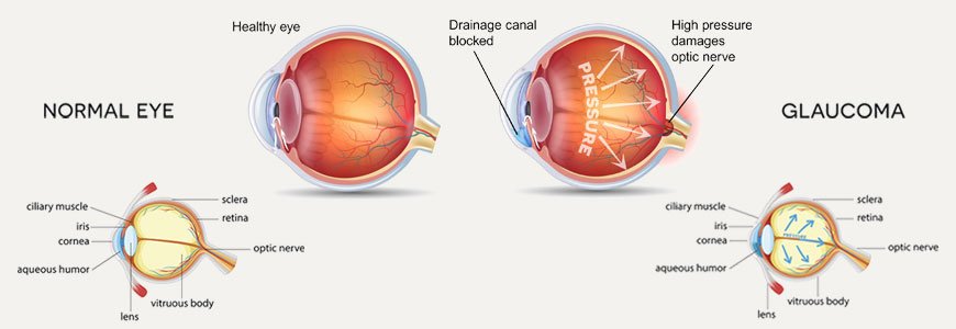 Glaucoma