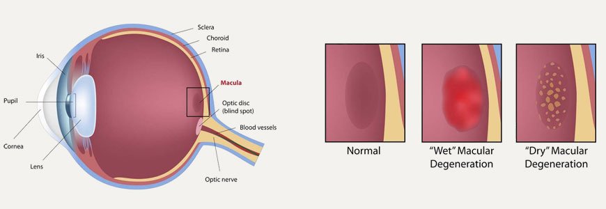 Macular Degeneration