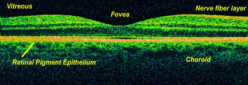 Optical Coherence Tomography