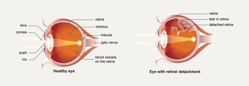 Retinal Detachment