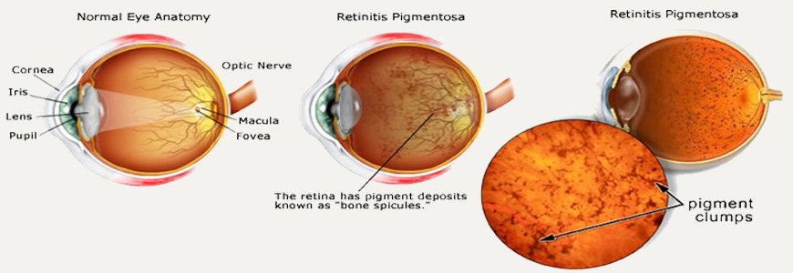 Retinitis Pigmentosa
