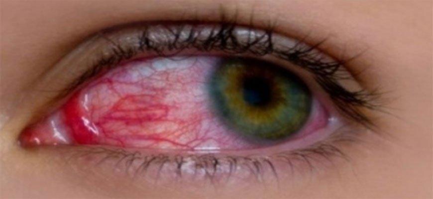 Uveitis