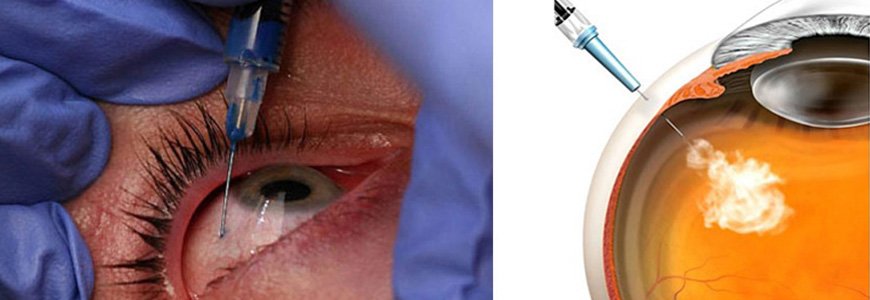 Anti VEGF Intra Vitreal Injections