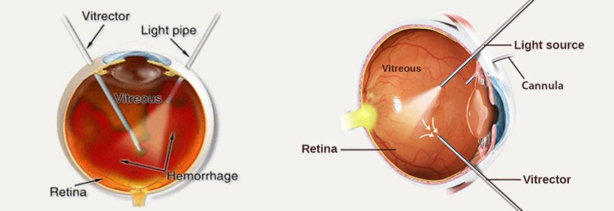 Vitrectomy Surgery