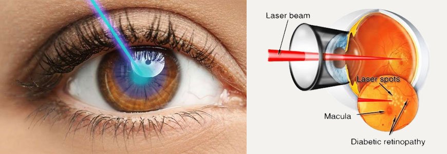 Laser Treatment