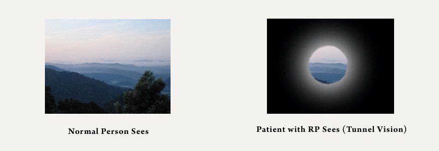 Symptoms of RP